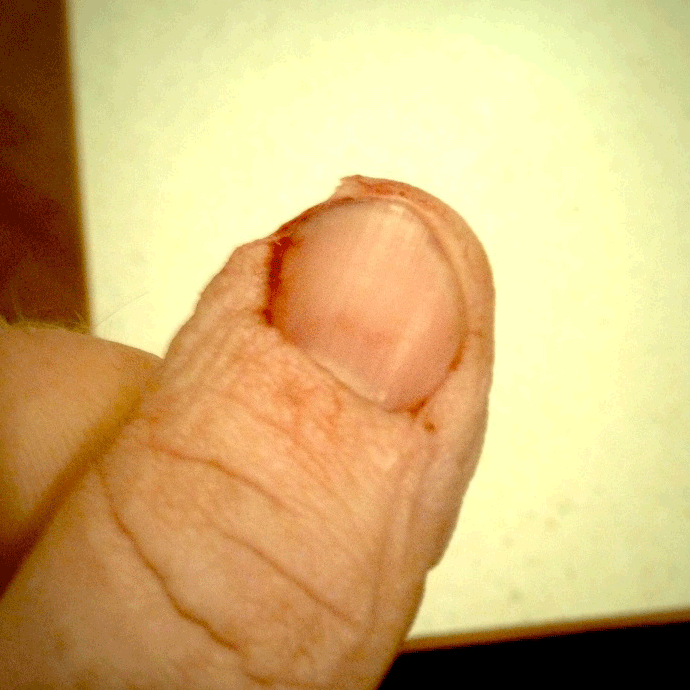 cut-finger