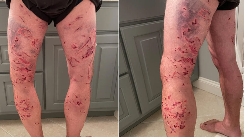 Georgia Hunter Mauled By Dogs While Moving Treestand