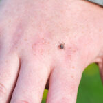 Over Half Of Wisconsin Deer Ticks Carry Lyme Disease